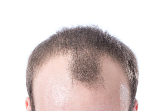 Minoxidil geheimratsecken vorher nachher